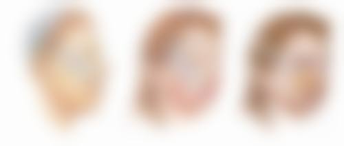 激光或射频治疗