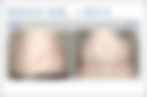 玻尿酸丰太阳穴与其他太阳穴填充方式的对比