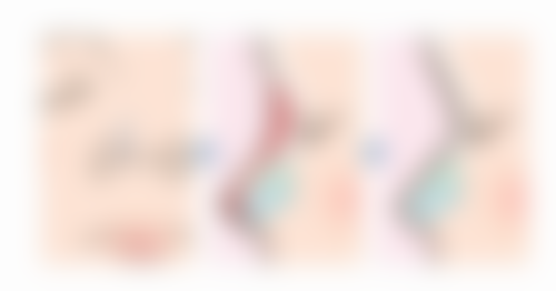 打瘦脸针吸烟有什么影响？揭秘吸烟对瘦脸针效果的3大阻碍，如何做让瘦脸效果更显著！ 