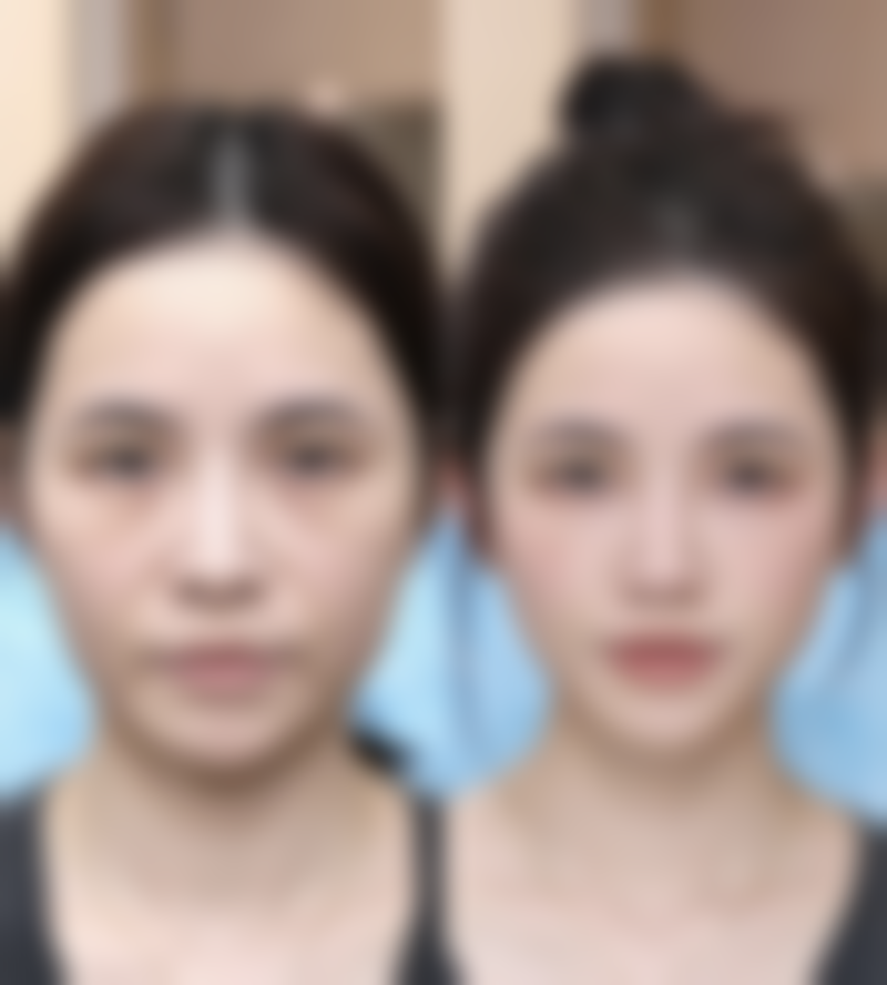 瘦脸针打完多久见效