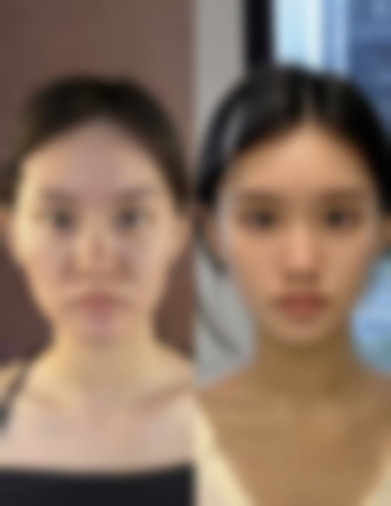 如何选择合适的玻尿酸和医生