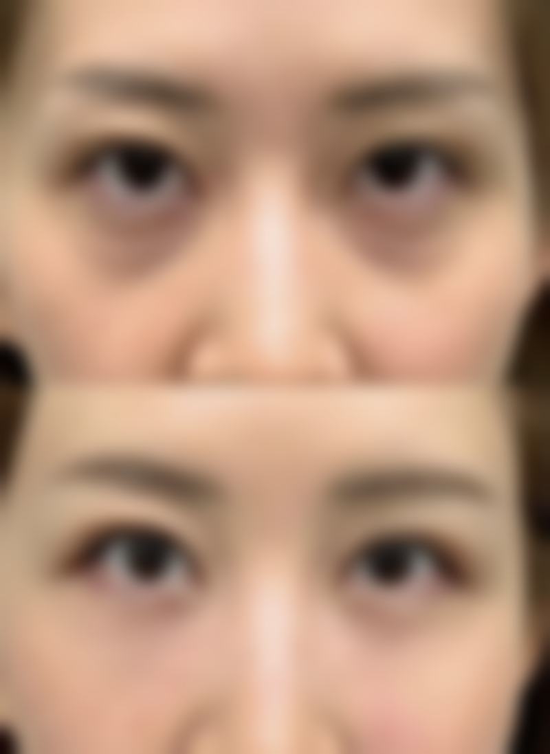 玻尿酸丰太阳穴的适用人群和禁忌人群