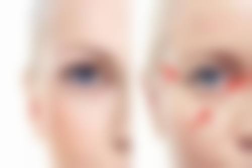 打瘦脸针的其他疑问解答