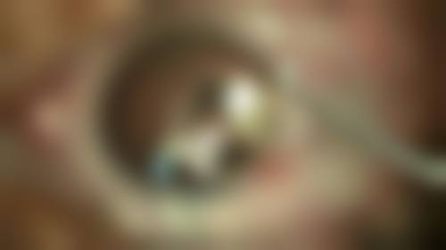 瘦脸针打几次就恒久了