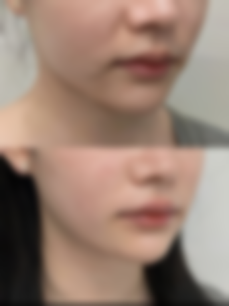 保妥适瘦脸针的好处