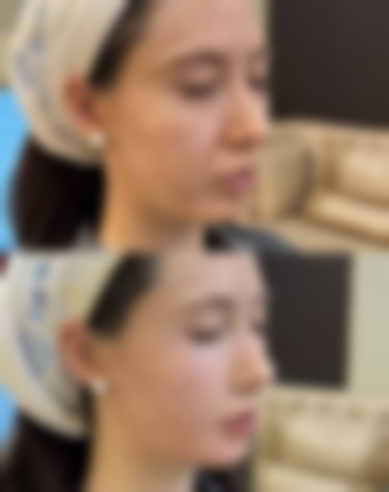 打瘦脸针的注意事项