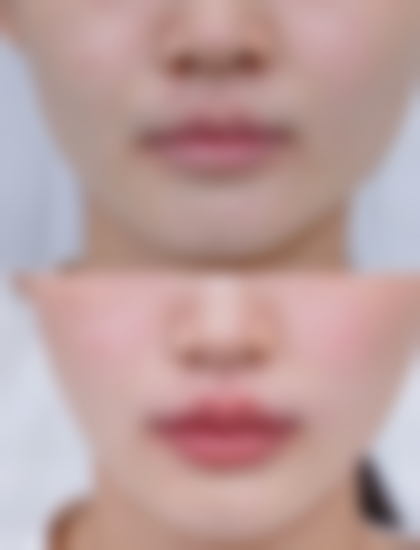 厚唇改薄整容哪里好？揭秘3家口碑医美机构，技术靠谱效果自然，助你轻松拥有迷人薄唇！ 