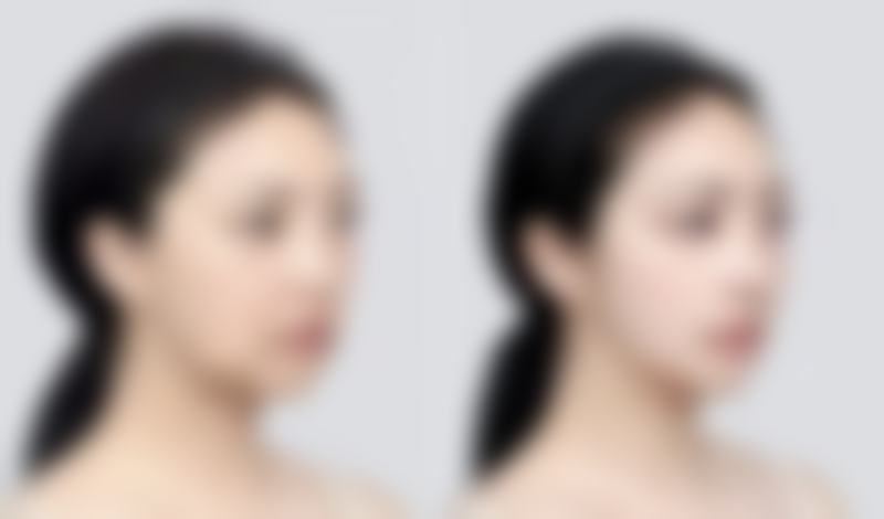 瘦脸针的危害和副作用