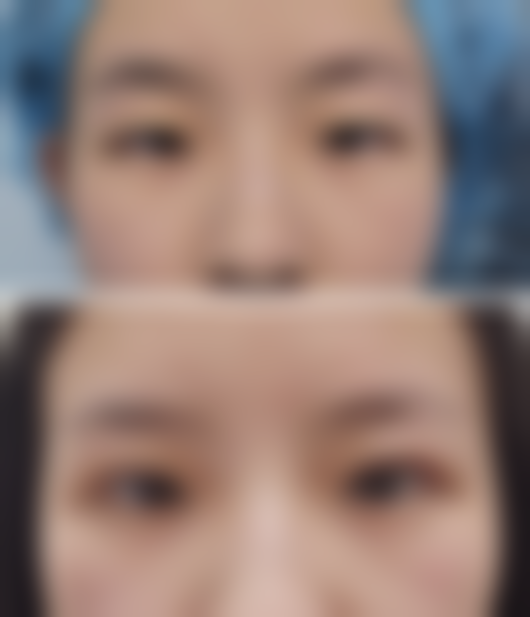 打一次瘦脸针有什么危害和副作用吗