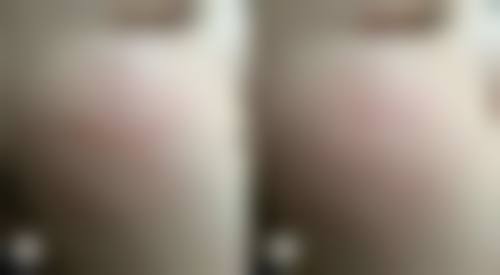 自己能给自己打瘦脸针吗视频、图片详解