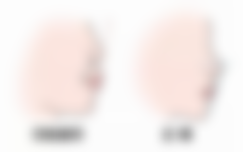 瘦脸针打一次能修复原样吗