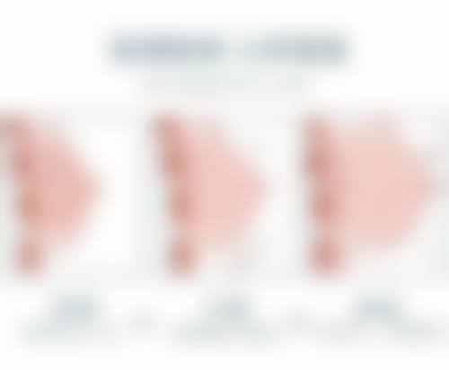 阴道缩小手术过程是怎样的