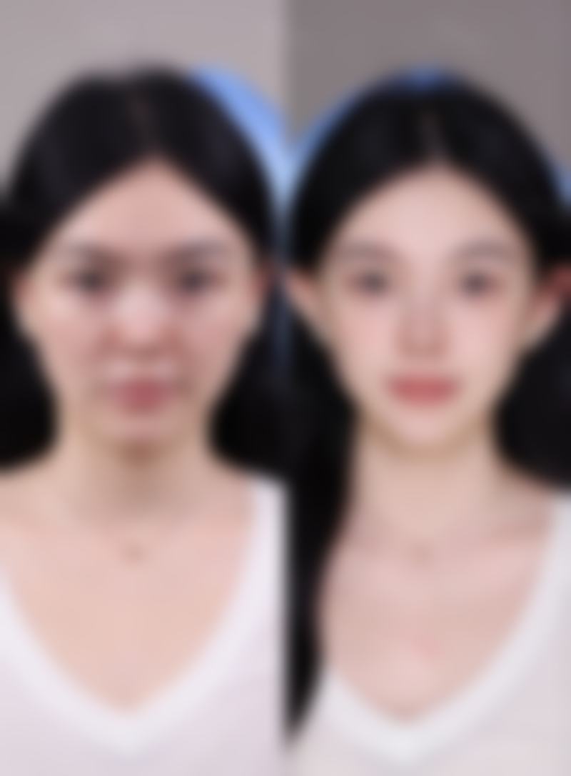 打瘦脸针脸颊凹陷图片能说明什么