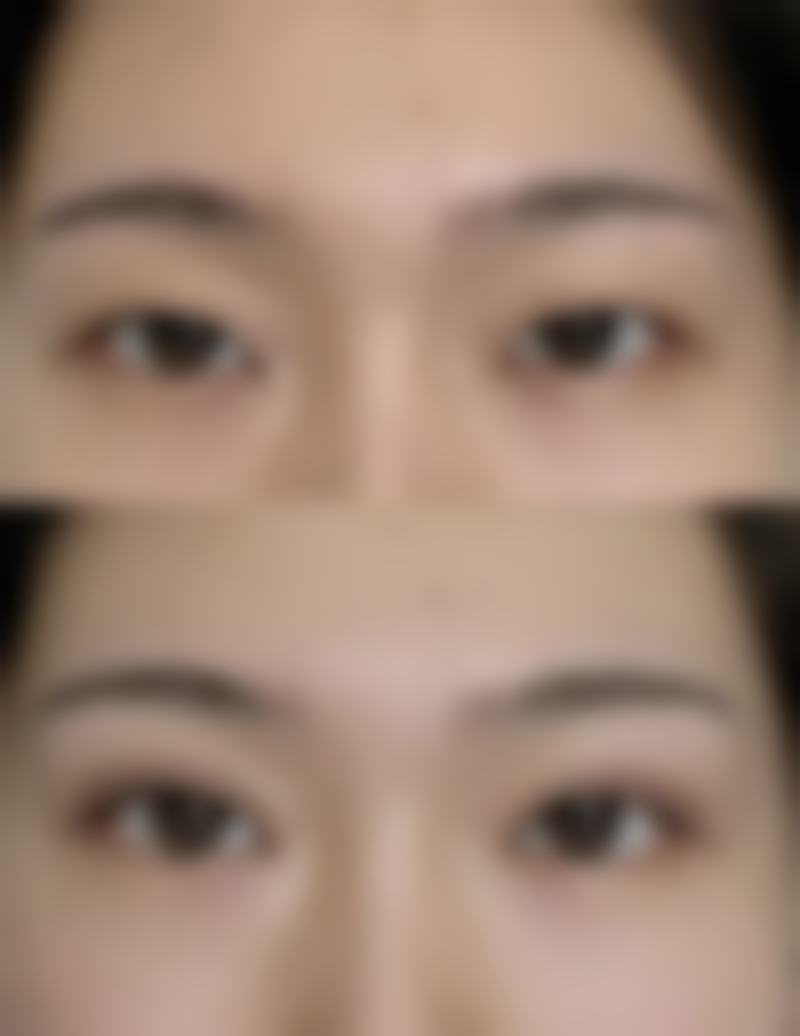 阴道缩小手术的方式有哪些