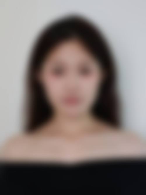 首先,医院在毛发移植方面具有先发优势,是国内较早专注于此领域的医院,经过多年的发展,积累了丰富的临床经验。其次,其移植成活率高,这是衡量毛发移植手术成功与否的重要指标,高成活率意味着患者能够获得更好的植发成效。再者,医院的团队配合默契,从术前的询问、方案制定,到术中的操作,再到术后的护理,各个环节都能紧密衔接,为患者提供全方面的服务。另外,医院开展的项目丰富多样,能够满足不同患者的多种需求,这也是其核心优势之一。