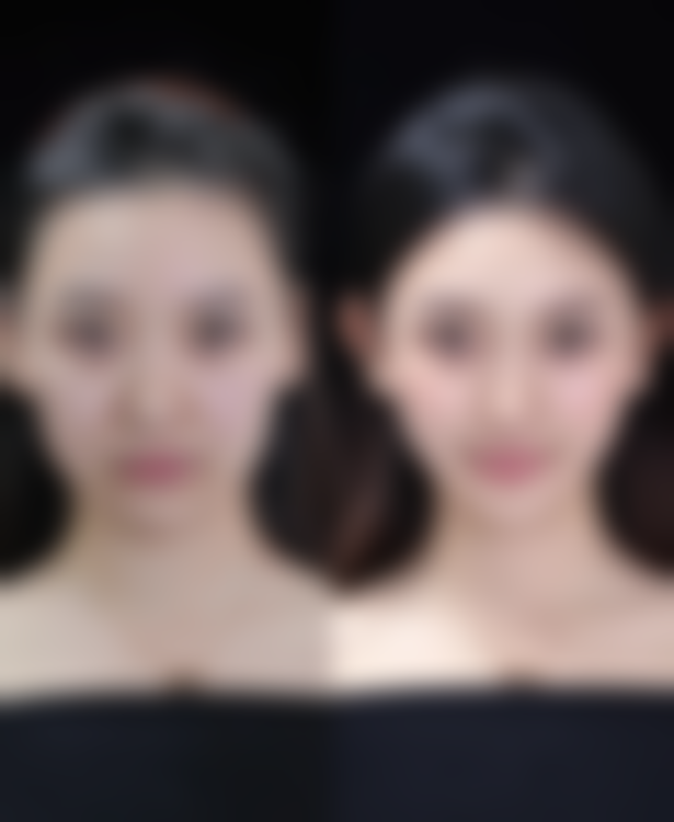 玻尿酸注射卧蚕可以维持多久