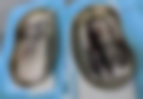 注射美白针效果如何？揭秘美白针三大显著效果，让你肌肤白提亮3个度！还能改善暗沉、淡化色斑！ 