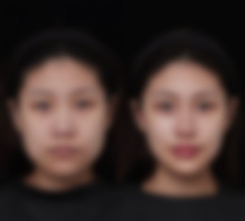 种植头发大概多少钱