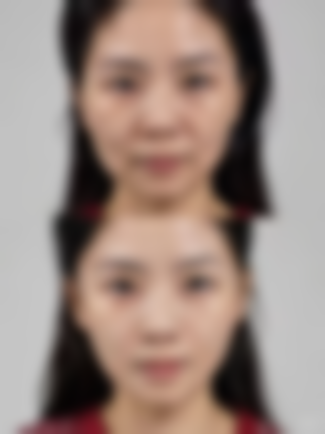 瘦脸针在哪里打