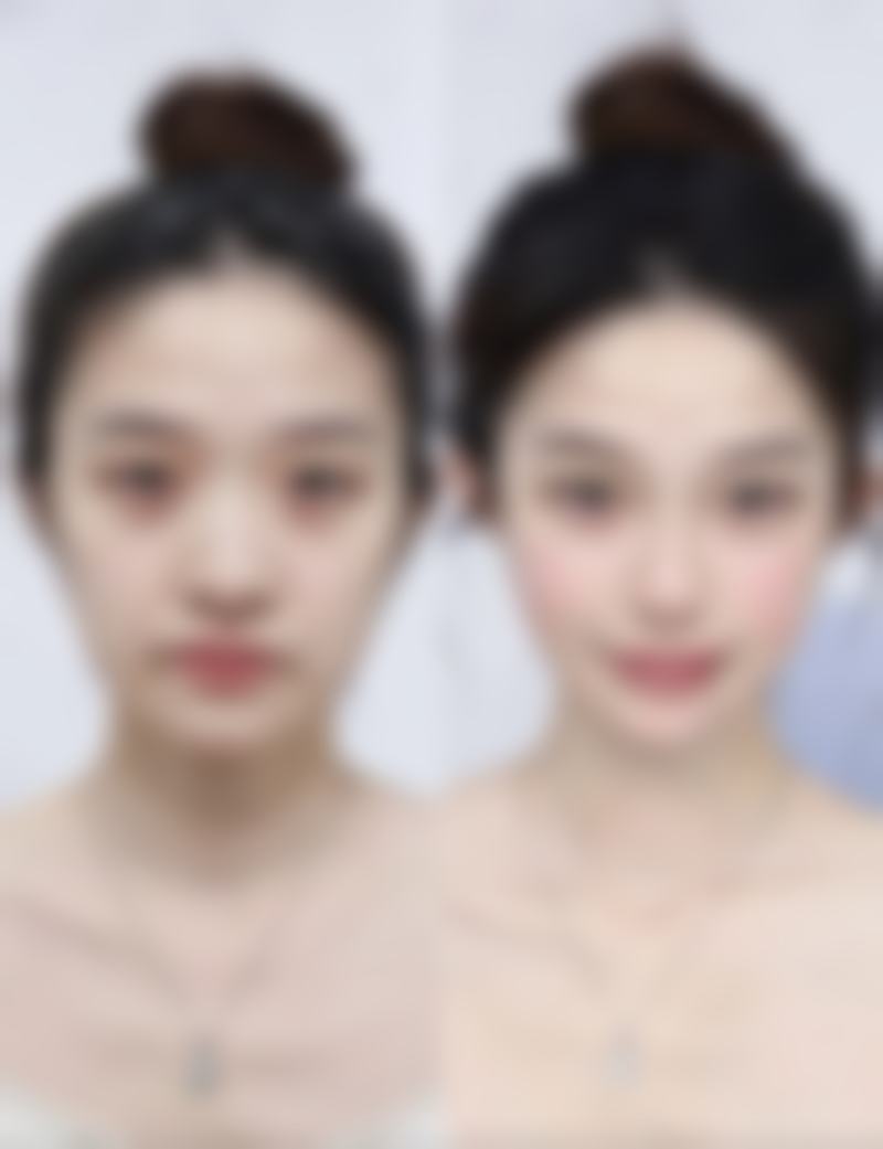 嘴唇缝针疤痕怎么祛除小妙招