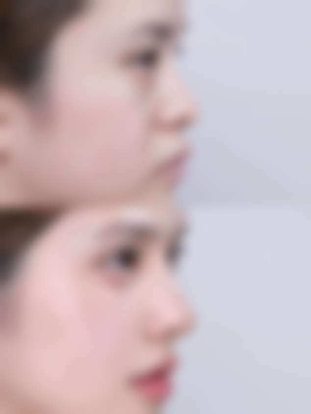 嘴唇缝针后疤痕图片及祛除图片