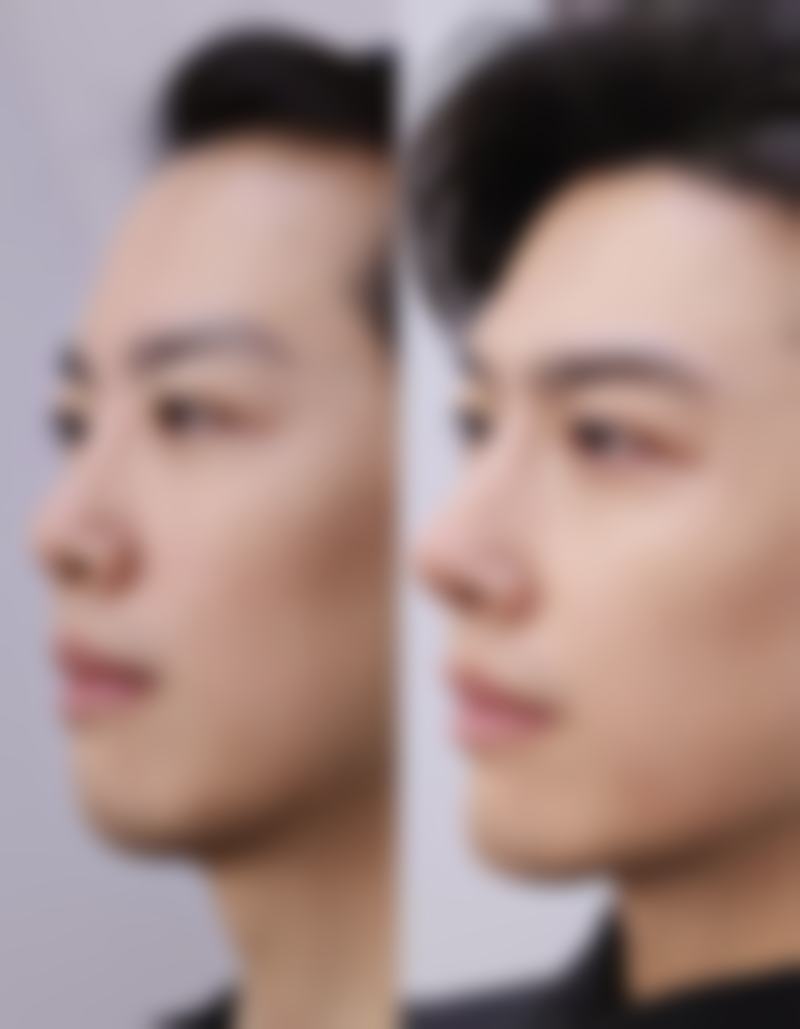 瘦脸针打完注意事项有什么忌口