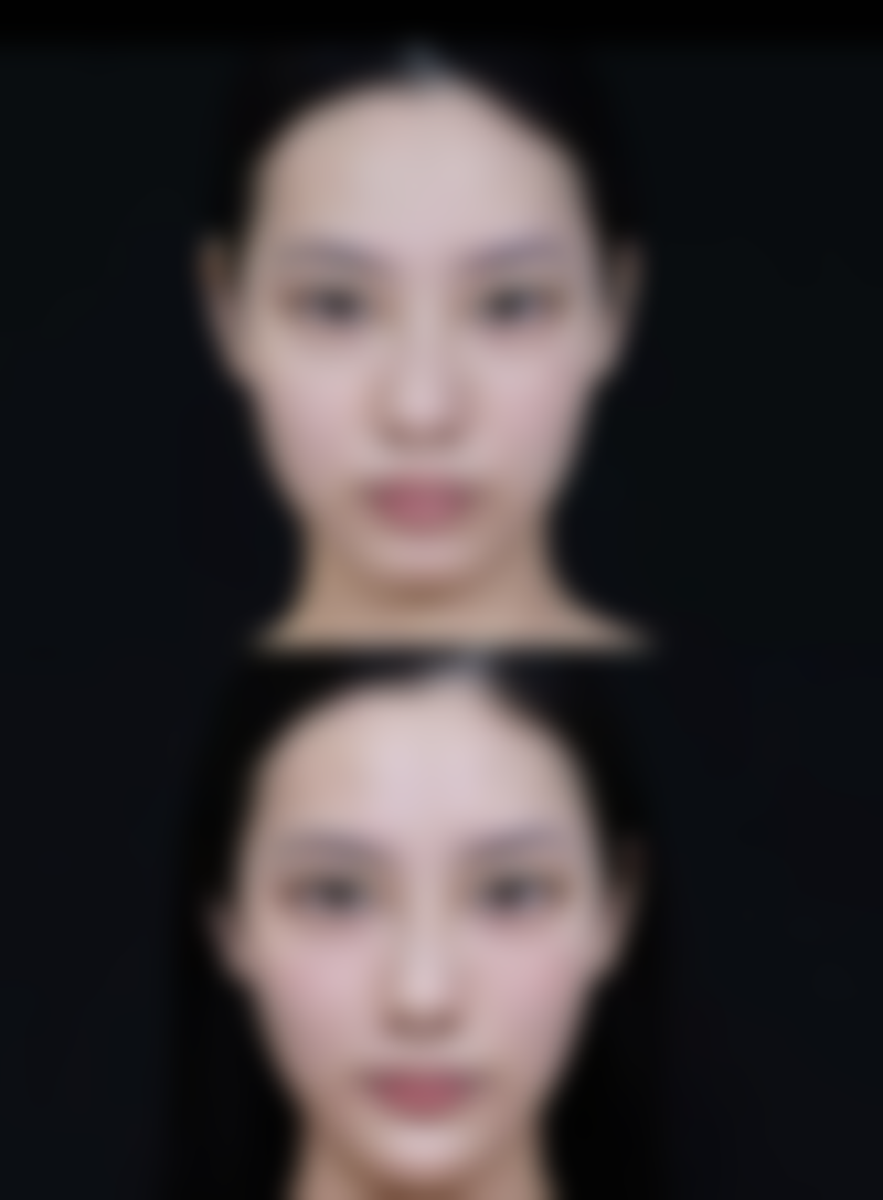 嘴唇缝针疤痕怎么祛除？揭秘3种医美妙招，安全无痛高效淡化，让你的嘴唇重焕自然光彩！ 