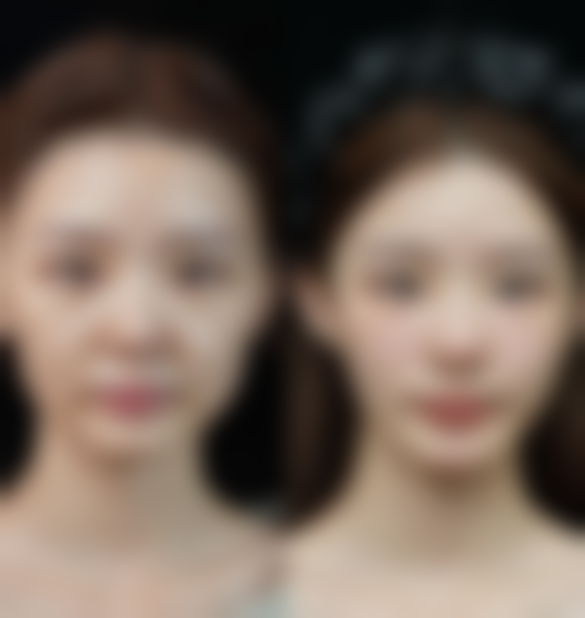 打完瘦脸针多久可以洗脸