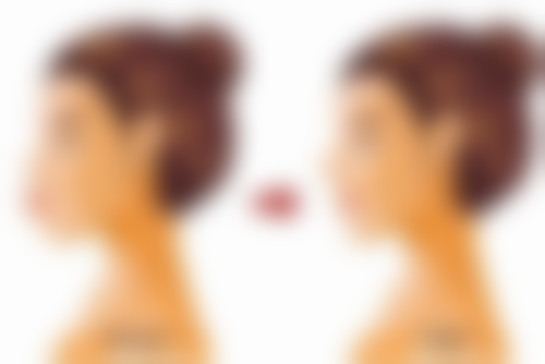 种植头发5年后真实感受