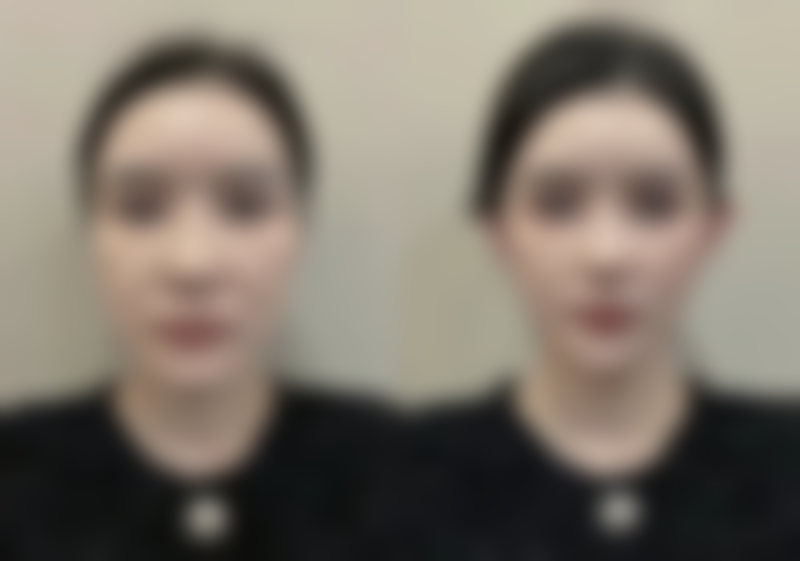 下嘴唇厚可以改薄吗？医美揭秘：90%人不知的下嘴唇改薄靠谱方法，效果显著还安全！ 