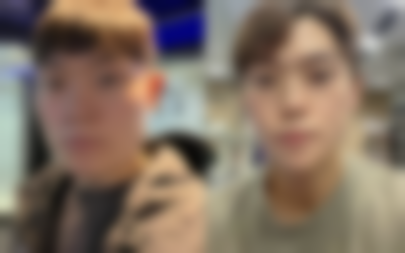 真人实例分享:厚唇改薄术后的惊喜变化