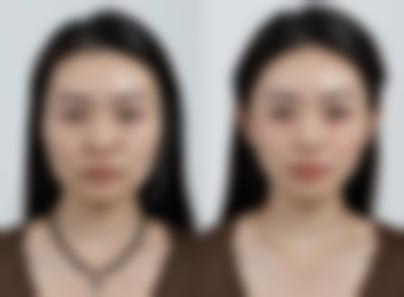 头发种植能保持多久时间