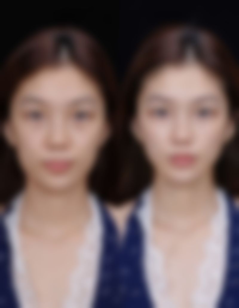 除皱针可以维持多长时间