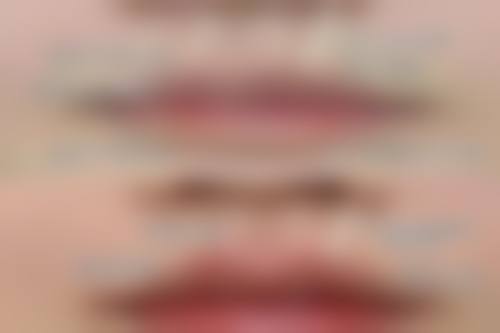 打完瘦脸针苹果肌下垂会恢复吗？权威揭秘：多数情况3 - 6个月可自然恢复，恢复方法大公开！ 