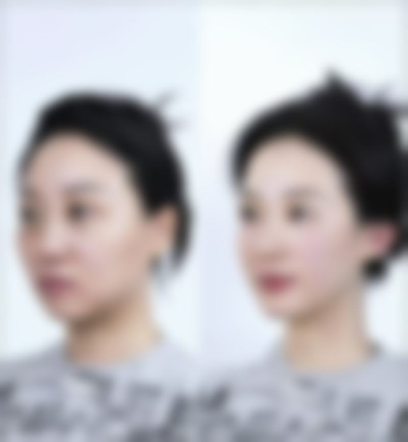 除皱针多久可以看到成效