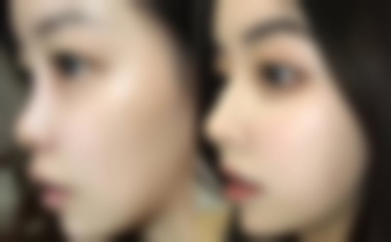 唇部疤痕可以修复吗图片及前后对比