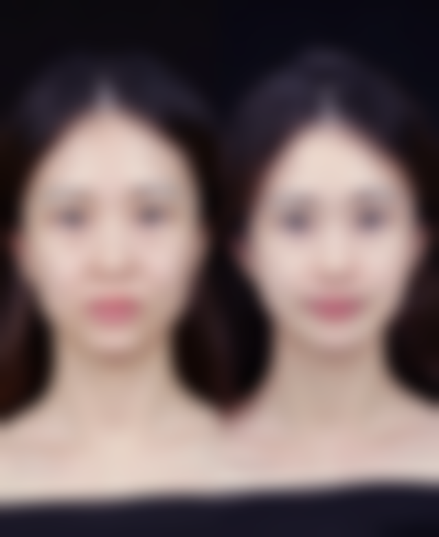 除皱针的危害和副作用