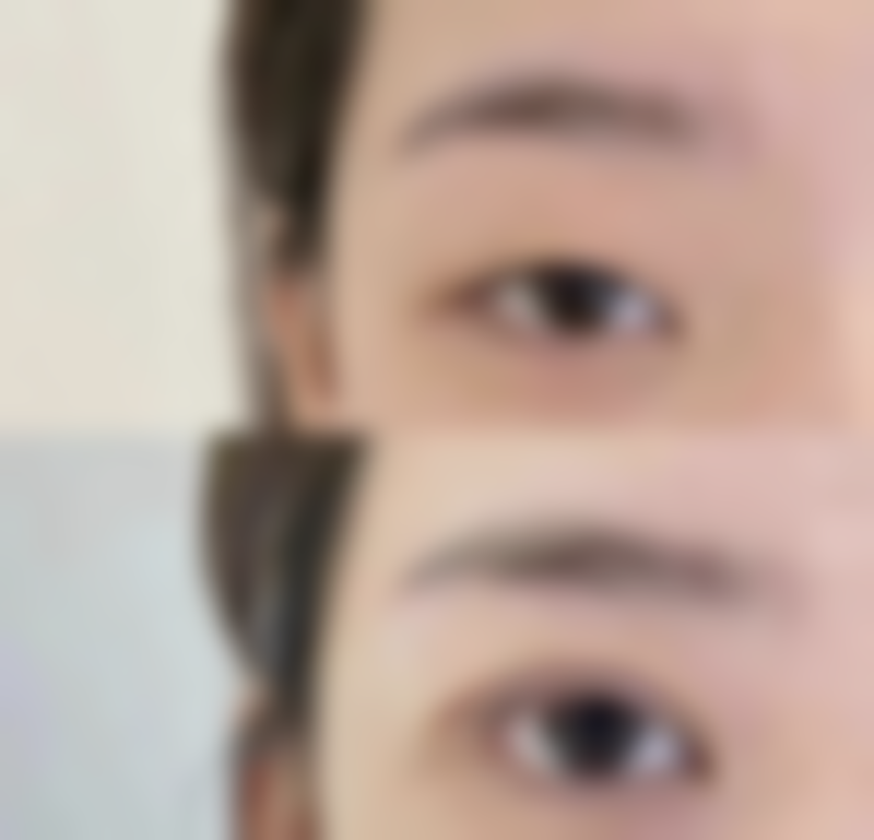 面上中1/3皮肤松弛面部除皱术式选择