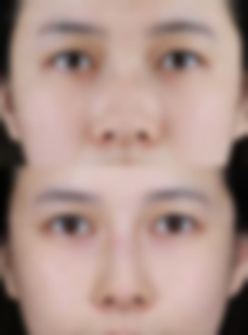 如何选择适合自己的除皱方式