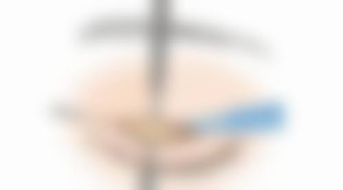 种植毛发的原理是什么？揭秘毛囊移植全过程，了解3大核心步骤，让你轻松拥有浓密秀发！ 