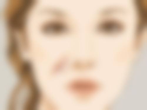 种植发际线需要几次