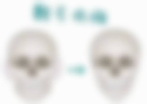 瘦脸针多久打一次可以维持恒久