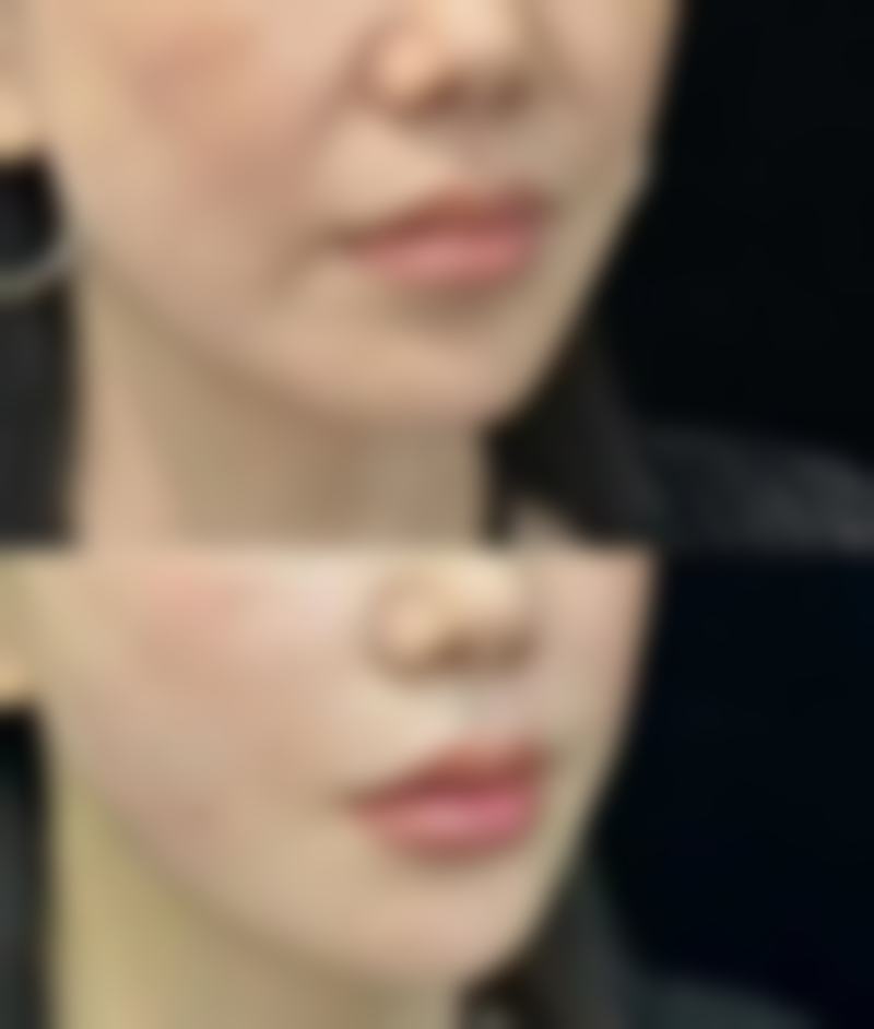 蓝毒瘦脸针与粉毒的对比