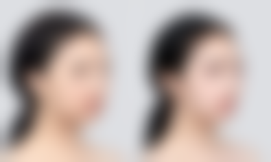 打完瘦脸针多久可以打微针