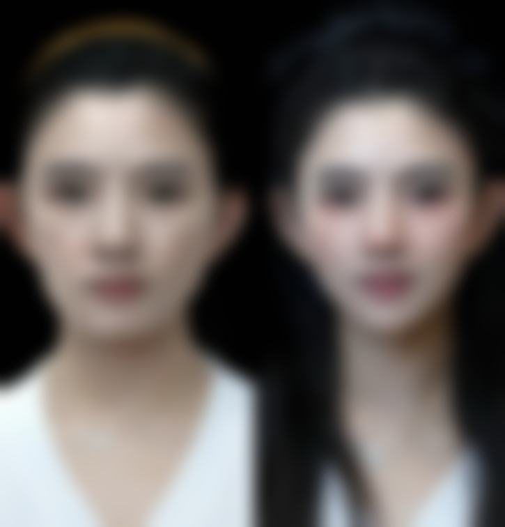 种植发际线怎么收费