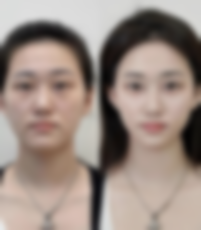 脸上打皱纹针是什么药水?