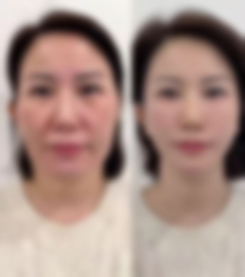 如何选择适合自己的阴道紧缩手术