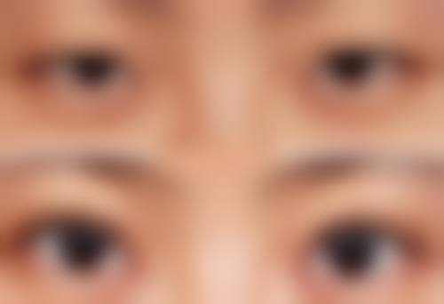 除皱除了打针还有其他办法吗？