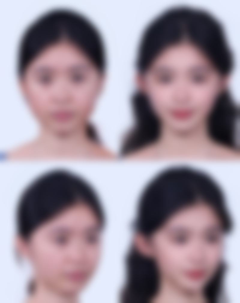 非手术方法让嘴巴变薄