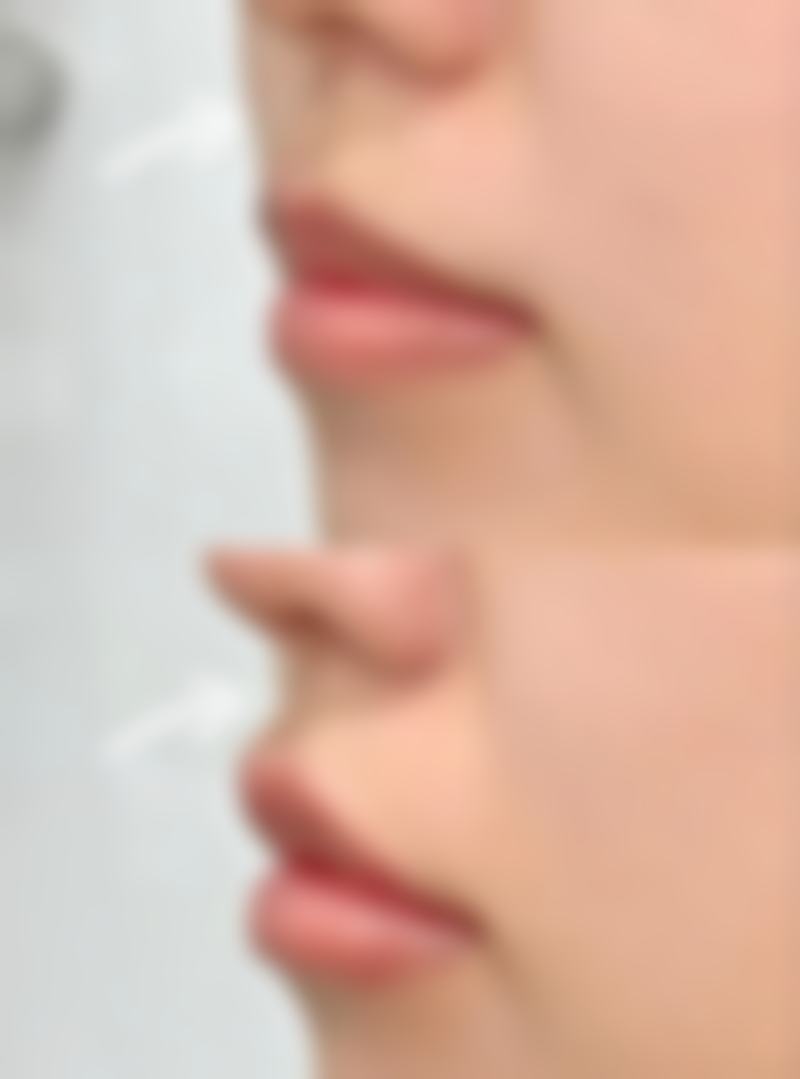 如何选择适合自己的除皱方法？